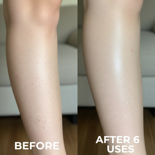 Clinically Advanced Triple-Acid Formula for Keratosis Pilaris