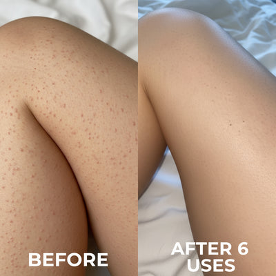 Clinically Advanced Triple-Acid Formula for Keratosis Pilaris