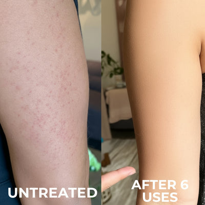 Clinically Advanced Triple-Acid Formula for Keratosis Pilaris